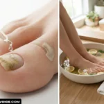 toenail fungus home remedy