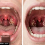 tonsillitis vs strep throat